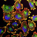 Fluorescence microscopy image of metastatic melanoma cells